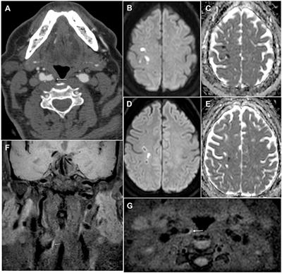 Non-stenotic Carotid Plaques in Embolic Stroke of Unknown Source